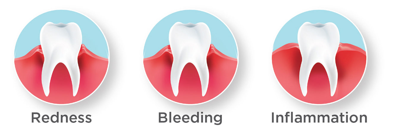 Early gum disease symptoms: bleeding, redness and irritation